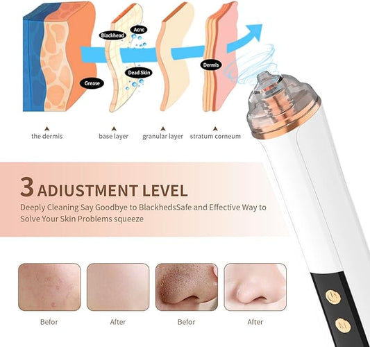 Blackhead Remover Pore Vacuum Kit  USB Rechargeable